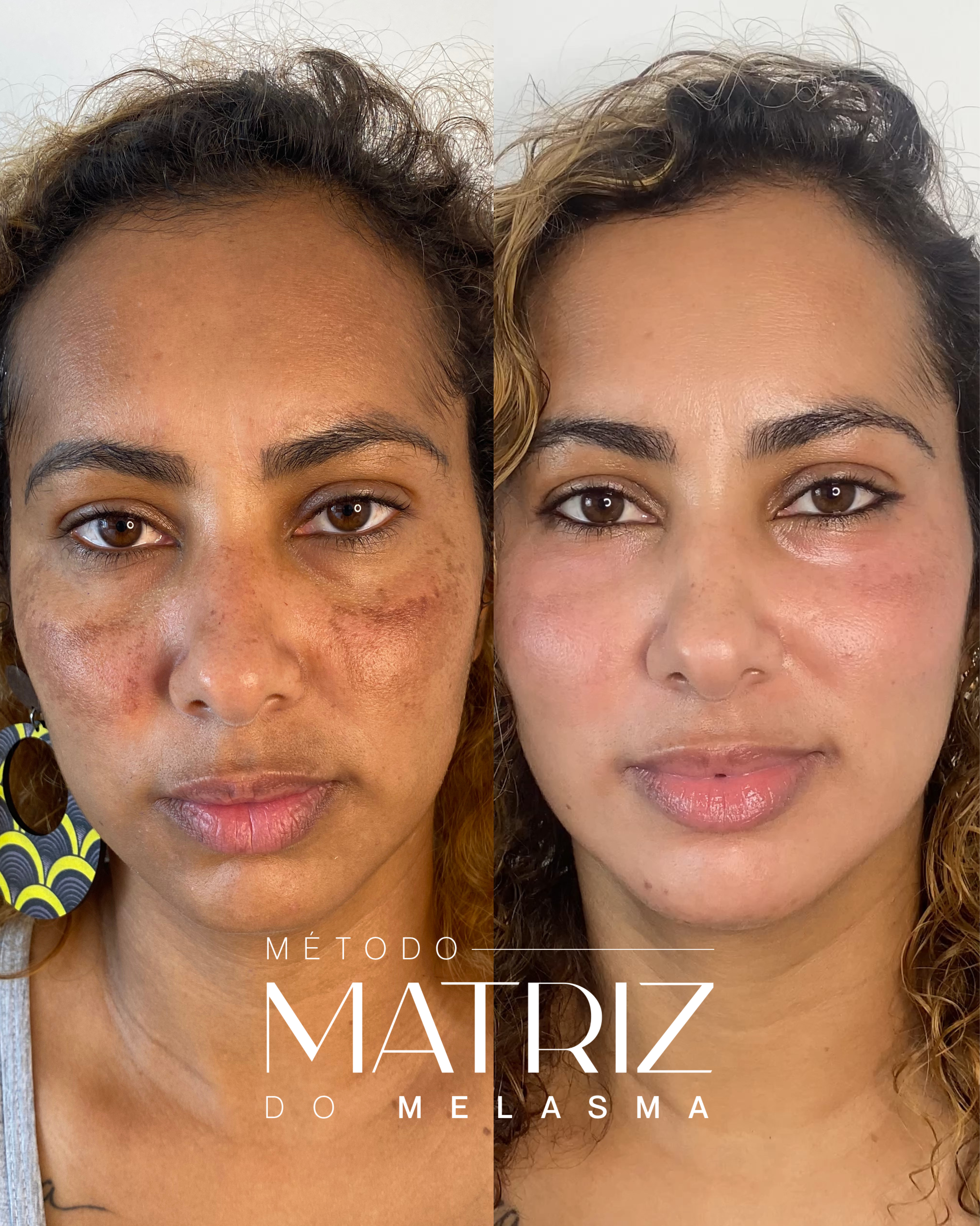Nicole Carvalho — Biomédica e Expert em Melasma