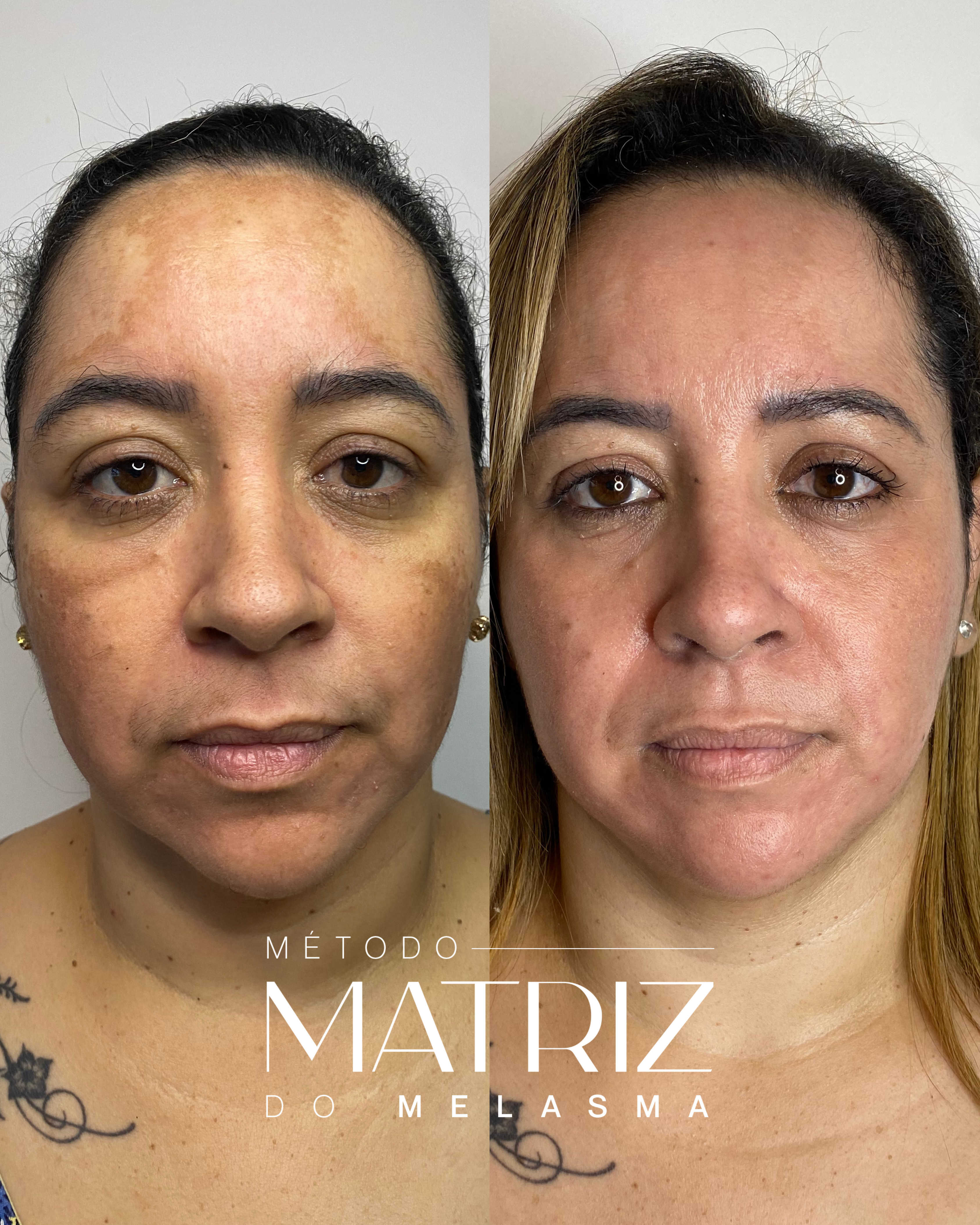 Nicole Carvalho — Biomédica e Expert em Melasma