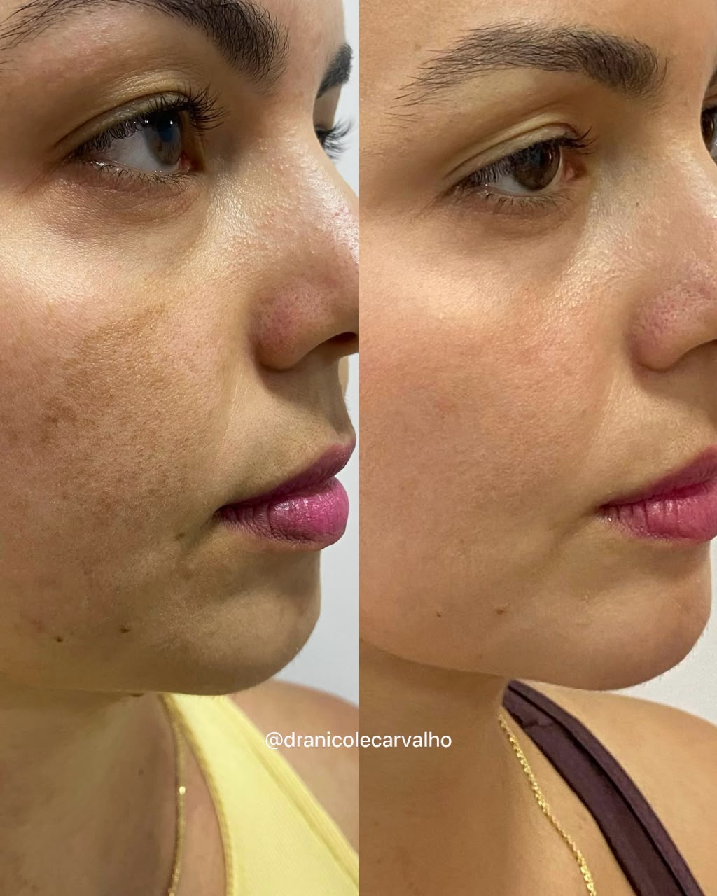Evolução acompanhada com investigação da raiz biológica do melasma